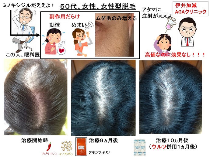 円形脱毛症　病院